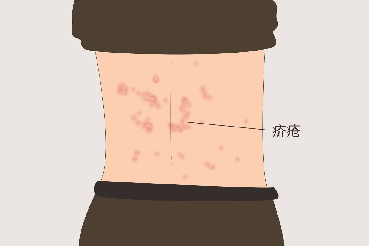 疥疮什么症状(疥疮什么症状表现)
