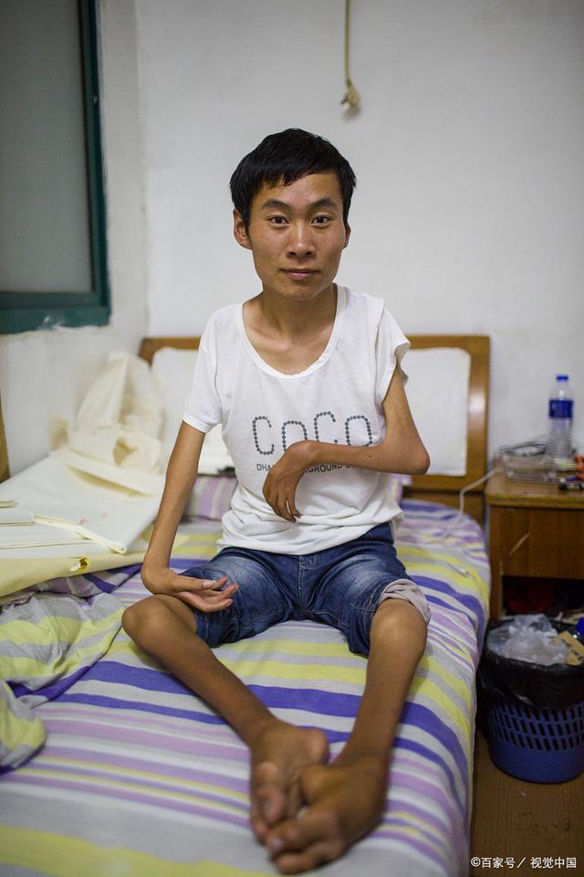 渐冻人早期症状(渐冻人早期症状是什么)